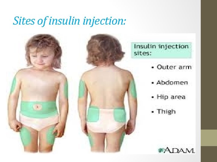 Sites of insulin injection: 