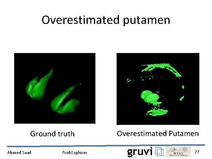 Overestimated putamen Ground truth Ahmed Saad Prob. Explorer Overestimated Putamen 27 