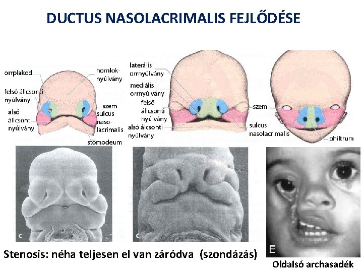 DUCTUS NASOLACRIMALIS FEJLŐDÉSE Stenosis: néha teljesen el van záródva (szondázás) Oldalsó archasadék 