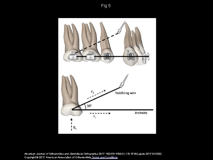 Miniscrew biomechanics Guidelines for the use of rigid