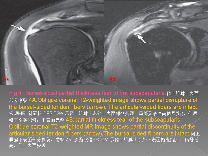 4 A 4 B Fig 4: Bursal-sided partial thickness tear of the subscapularis. 冈上肌腱上表面