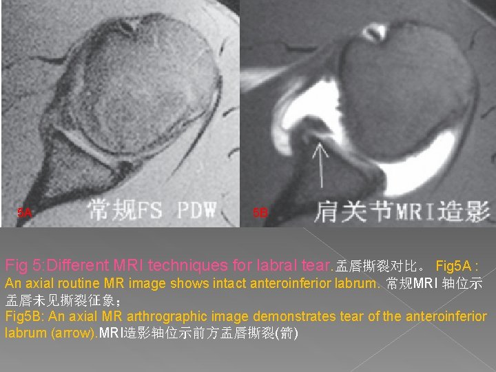 5 A 5 B Fig 5: Different MRI techniques for labral tear. 盂唇撕裂对比。 Fig