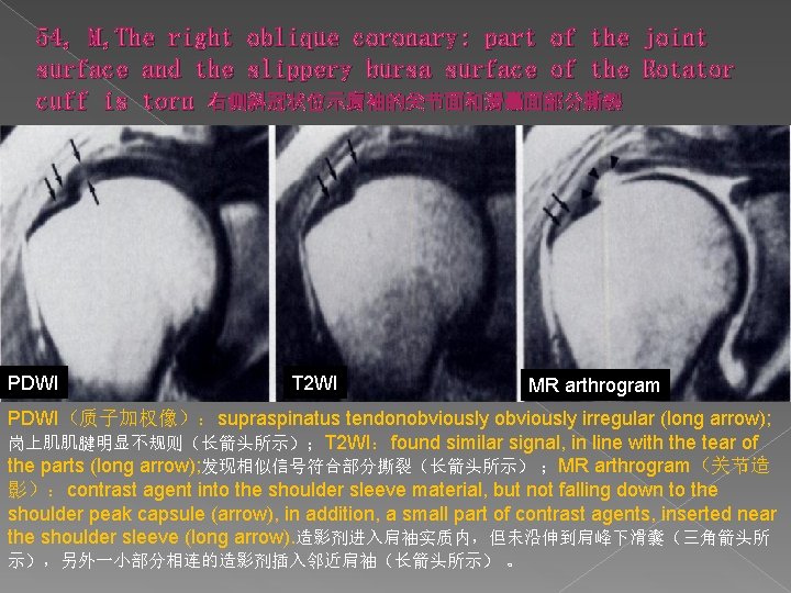 54, M, The right oblique coronary: part of the joint surface and the slippery