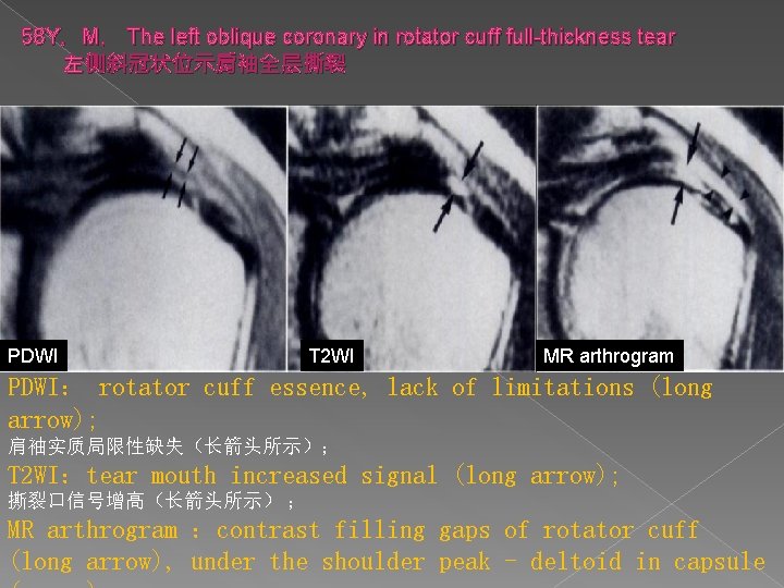 58 Y，M， The left oblique coronary in rotator cuff full-thickness tear 左侧斜冠状位示肩袖全层撕裂 PDWI T