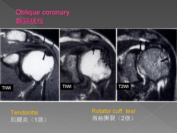 Oblique coronary 斜冠状位 TIWI Tendonitis 肌腱炎（1级） TIWI T 2 WI Rotator cuff tear 肩袖撕裂（2级）