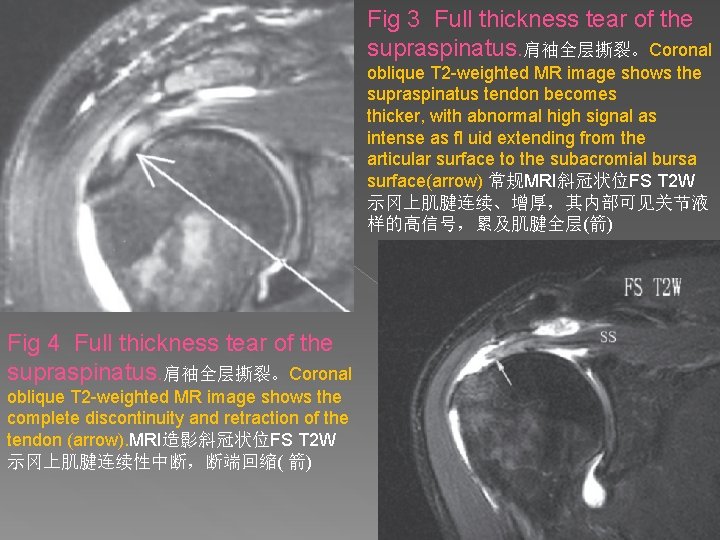 Fig 3 Full thickness tear of the supraspinatus. 肩袖全层撕裂。Coronal oblique T 2 -weighted MR