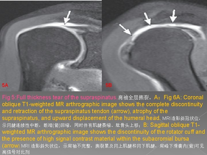 5 A 5 B Fig 5: Full thickness tear of the supraspinatus. 肩袖全层撕裂。A：Fig 6
