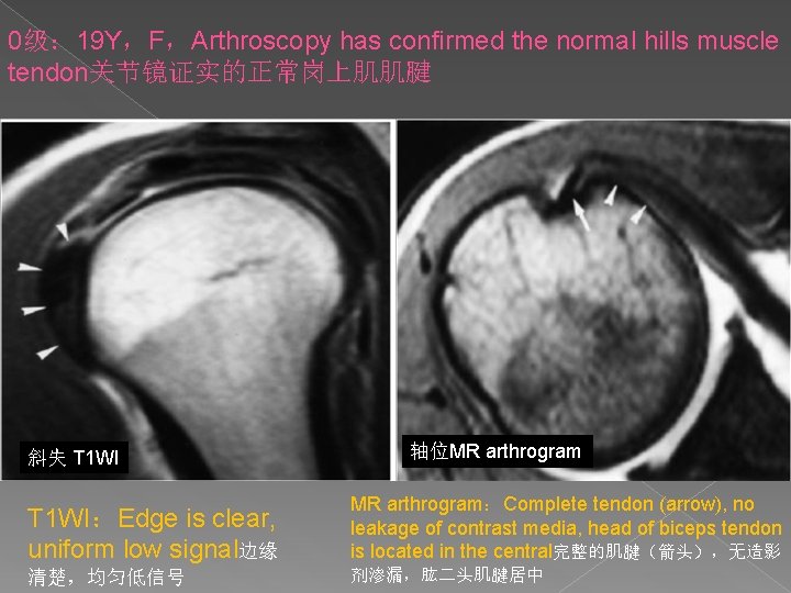 0级： 19 Y，F，Arthroscopy has confirmed the normal hills muscle tendon关节镜证实的正常岗上肌肌腱 斜失 T 1 WI