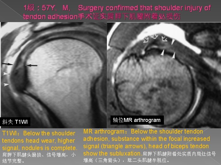 1级： 57 Y，M， Surgery confirmed that shoulder injury of tendon adhesion手术证实肩胛下肌腱附着处损伤 斜失 T 1