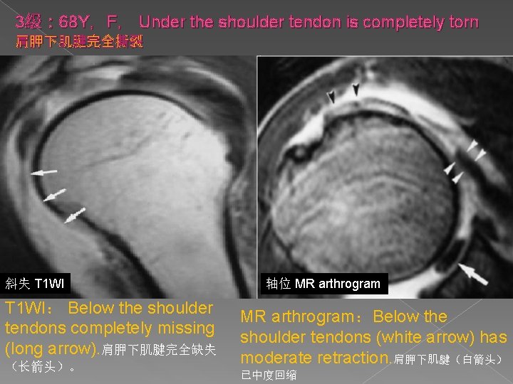 3级： 68 Y，F， Under the shoulder tendon is completely torn 肩胛下肌腱完全撕裂 斜失 T 1