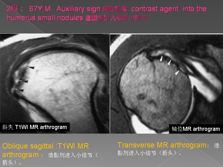 2级： 67 Y, M. Auxiliary sign 辅助征像: contrast agent into the humerus small nodules