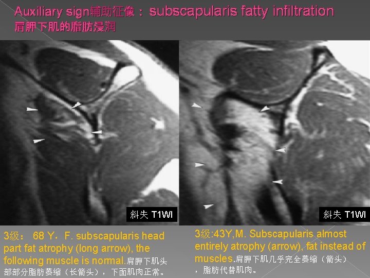 Auxiliary sign辅助征像： subscapularis fatty infiltration 肩胛下肌的脂肪浸润 斜失 T 1 WI 3级： 68 Y，F. subscapularis