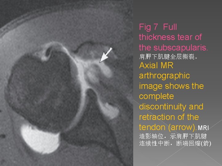 Fig 7 Full thickness tear of the subscapularis. 肩胛下肌腱全层撕裂。 Axial MR arthrographic image shows