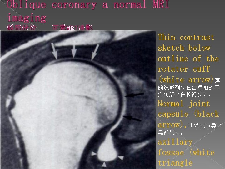 Oblique coronary a normal MRI imaging 斜冠状位 正常MRI造影 Thin contrast sketch below outline of