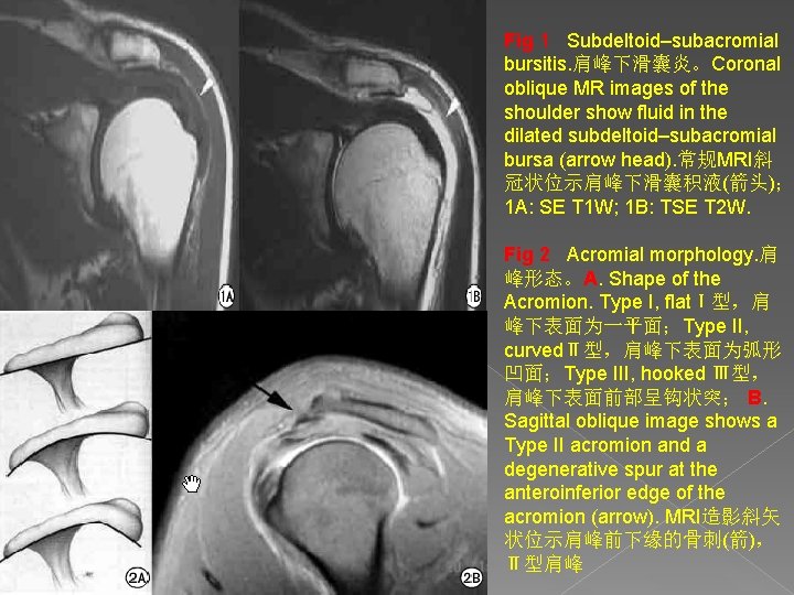 Fig 1 Subdeltoid–subacromial bursitis. 肩峰下滑囊炎。Coronal oblique MR images of the shoulder show fluid in
