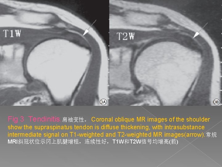 Fig 3 Tendinitis. 肩袖变性。 Coronal oblique MR images of the shoulder show the supraspinatus