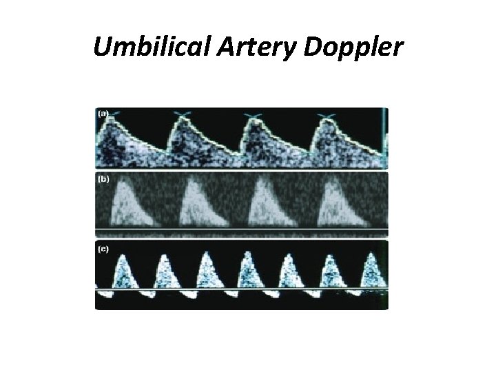 Umbilical Artery Doppler 