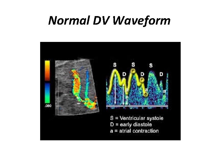 Normal DV Waveform 