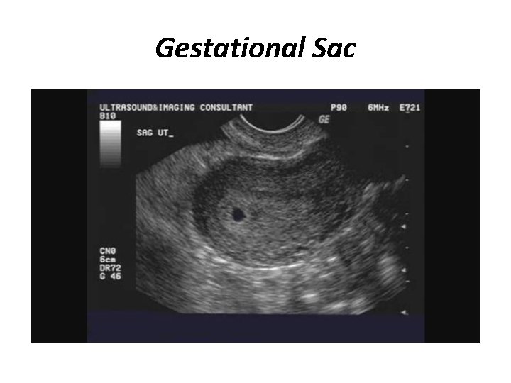 Gestational Sac 