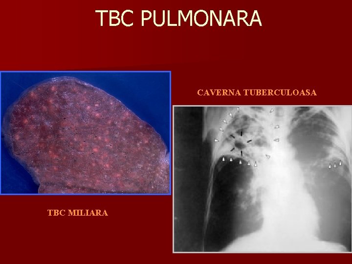 TBC PULMONARA CAVERNA TUBERCULOASA TBC MILIARA 