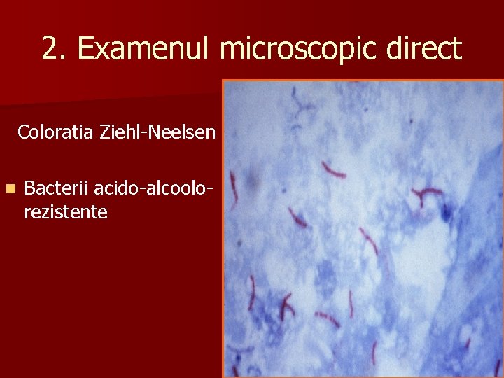 2. Examenul microscopic direct Coloratia Ziehl-Neelsen n Bacterii acido-alcoolorezistente 