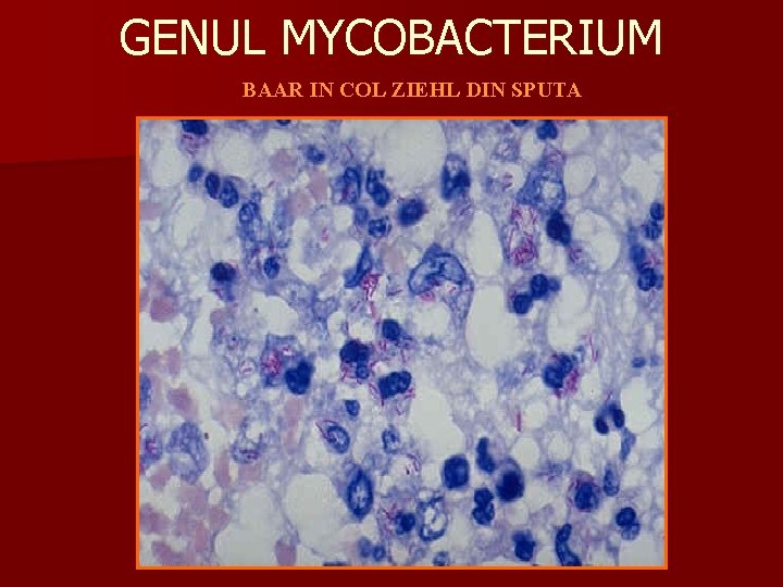 GENUL MYCOBACTERIUM BAAR IN COL ZIEHL DIN SPUTA 