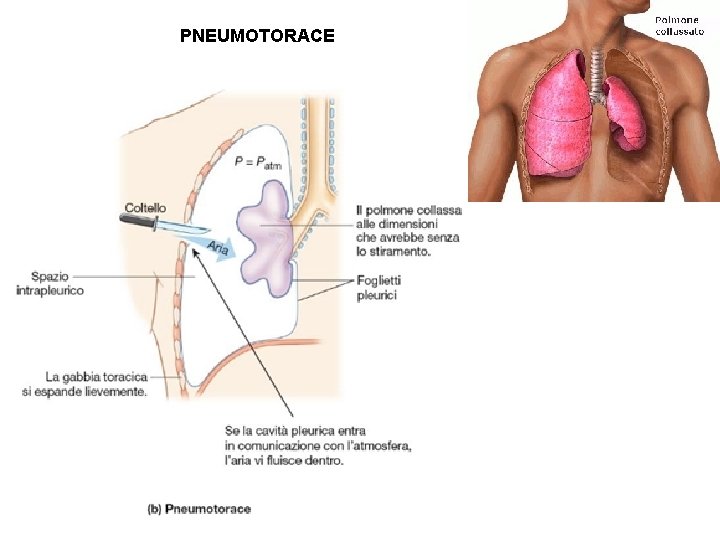 PNEUMOTORACE 