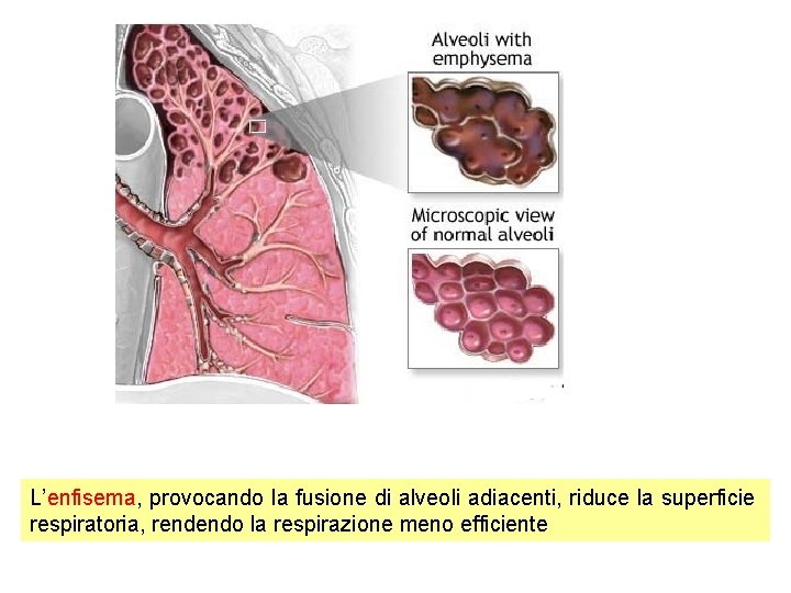 L’enfisema, provocando la fusione di alveoli adiacenti, riduce la superficie respiratoria, rendendo la respirazione