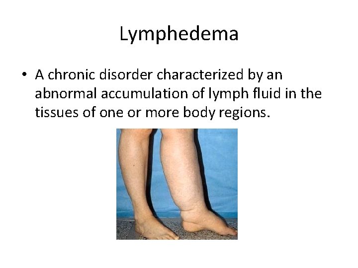Lymphedema • A chronic disorder characterized by an abnormal accumulation of lymph fluid in