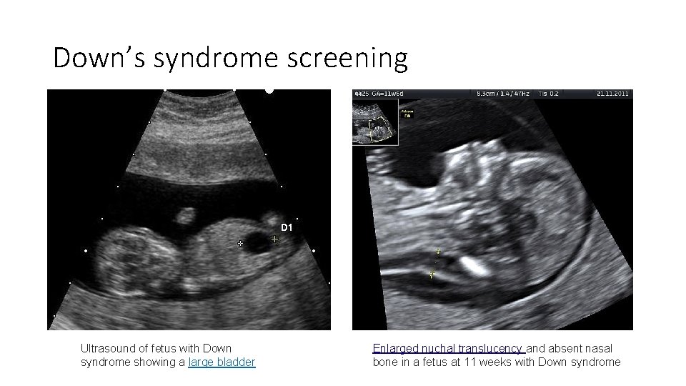 Down’s syndrome screening Ultrasound of fetus with Down syndrome showing a large bladder Enlarged