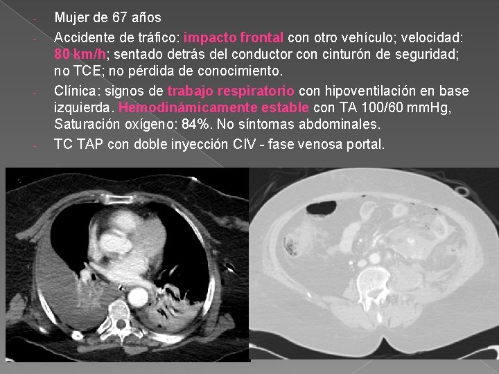 - - - Mujer de 67 años Accidente de tráfico: impacto frontal con otro