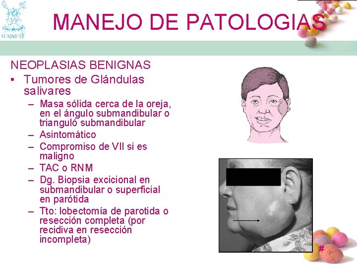 MANEJO DE PATOLOGIAS NEOPLASIAS BENIGNAS • Tumores de Glándulas salivares – Masa sólida cerca