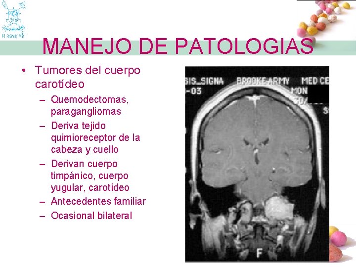 MANEJO DE PATOLOGIAS • Tumores del cuerpo carotídeo – Quemodectomas, paragangliomas – Deriva tejido