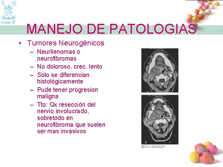 MANEJO DE PATOLOGIAS • Tumores Neurogénicos – Neurilenomas o neurofibromas – No doloroso, crec.