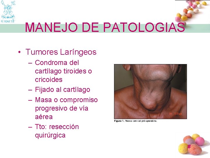 MANEJO DE PATOLOGIAS • Tumores Laríngeos – Condroma del cartílago tiroides o cricoides –
