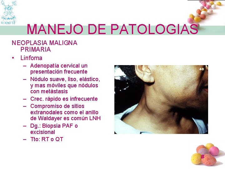 MANEJO DE PATOLOGIAS NEOPLASIA MALIGNA PRIMARIA • Linfoma – Adenopatía cervical un presentación frecuente