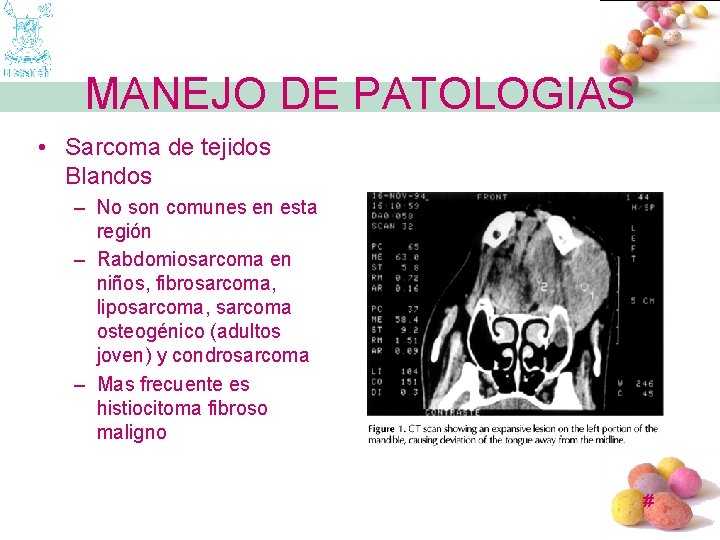 MANEJO DE PATOLOGIAS • Sarcoma de tejidos Blandos – No son comunes en esta