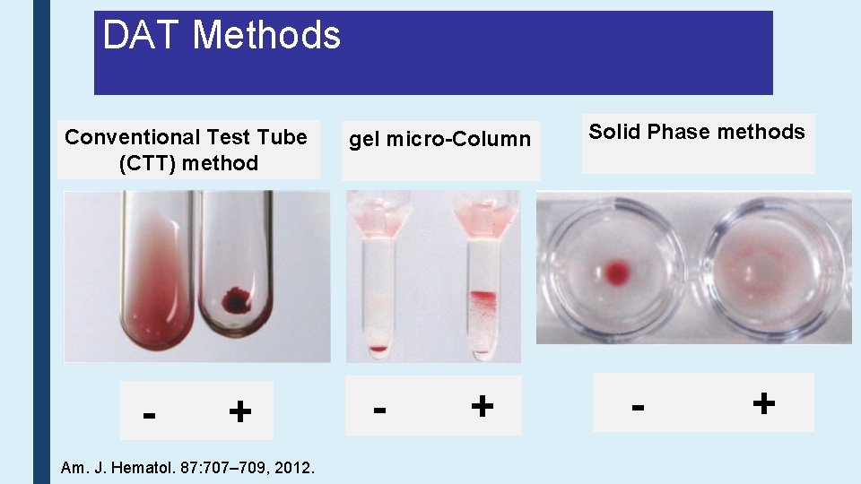 DAT Methods Conventional Test Tube (CTT) method - + Am. J. Hematol. 87: 707–