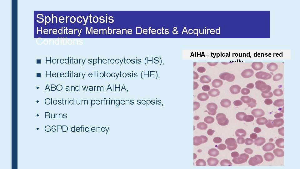 Spherocytosis Hereditary Membrane Defects & Acquired Conditions ■ Hereditary spherocytosis (HS), ■ Hereditary elliptocytosis