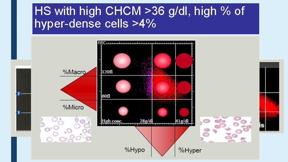 HS with high CHCM >36 g/dl, high % of hyper-dense cells >4% 
