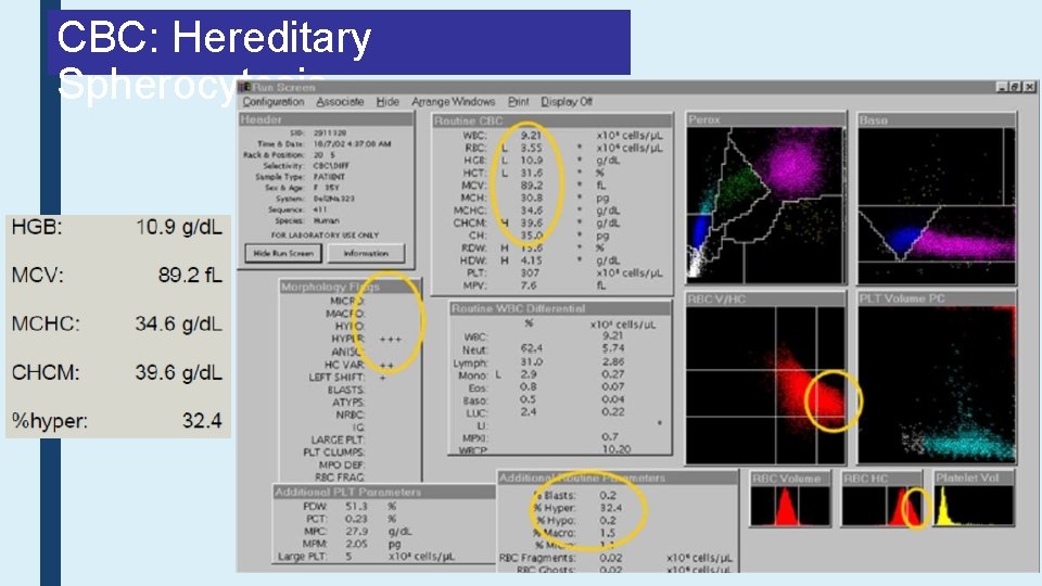 CBC: Hereditary Spherocytosis 