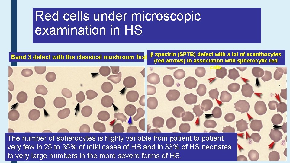 Red cells under microscopic examination in HS β spectrin (SPTB) defect with a lot