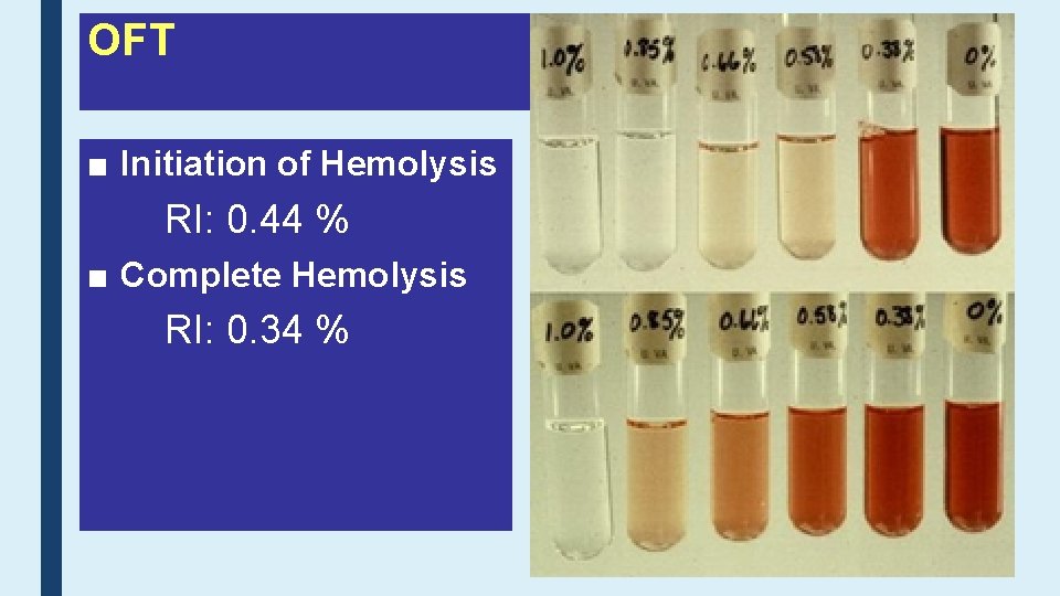 OFT ■ Initiation of Hemolysis RI: 0. 44 % ■ Complete Hemolysis RI: 0.