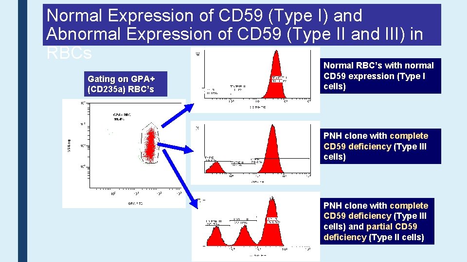 Normal Expression of CD 59 (Type I) and Abnormal Expression of CD 59 (Type