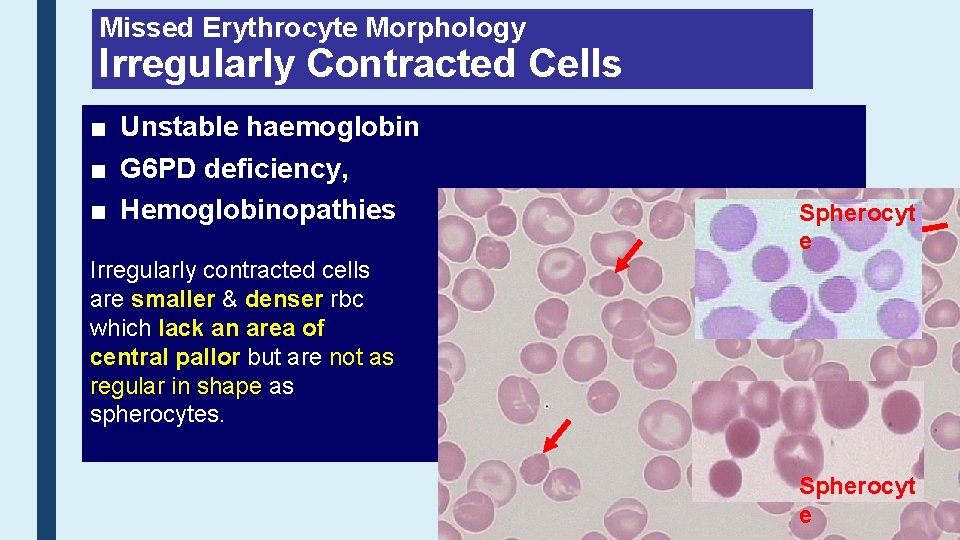 Missed Erythrocyte Morphology Irregularly Contracted Cells ■ Unstable haemoglobin ■ G 6 PD deficiency,