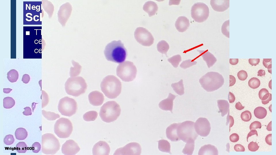 Neglected Erythrocyte Morphology Schistocytes ■ TTP, HUS, DIC – a wide range of fragmented