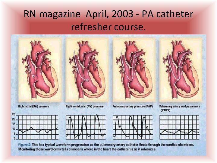 RN magazine April, 2003 - PA catheter refresher course.  RN magazine April, 2003 - PA catheter refresher course.