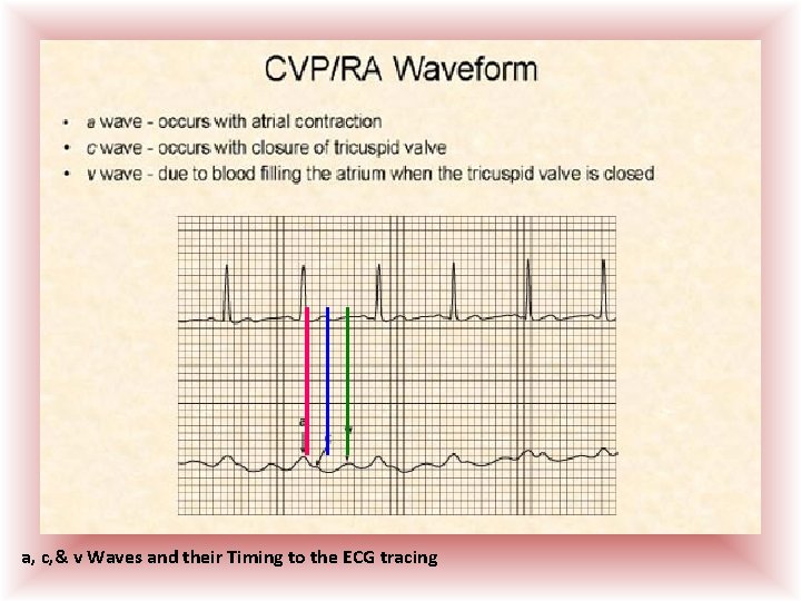 a, c, & v Waves and their Timing to the ECG tracing  a, c, & v Waves and their Timing to the ECG tracing