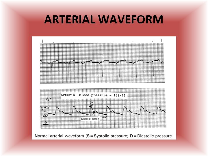 ARTERIAL WAVEFORM  ARTERIAL WAVEFORM