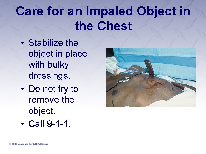 Care for an Impaled Object in the Chest • Stabilize the object in place Care for an Impaled Object in the Chest • Stabilize the object in place